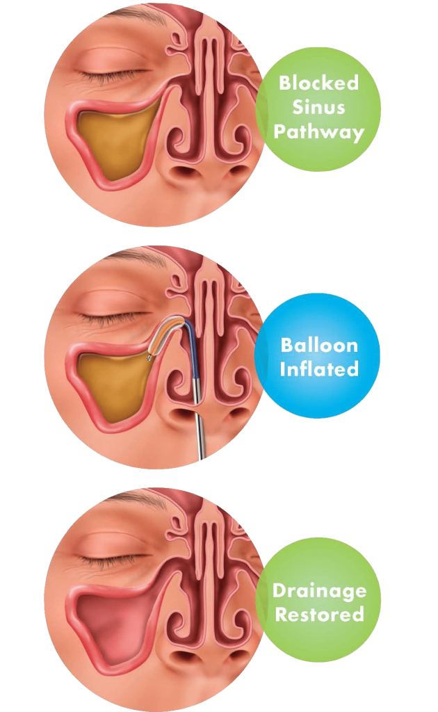 The Basics on Balloon Sinuplasty Phoenix PHX